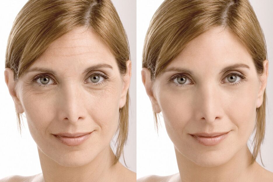 Experience of using before and after using intenskin cream from Milana