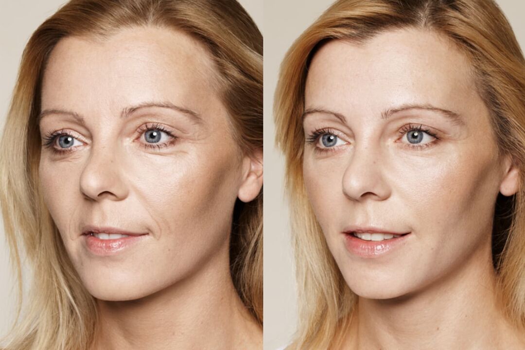 Experience of using before and after using intenskin cream from Valeria